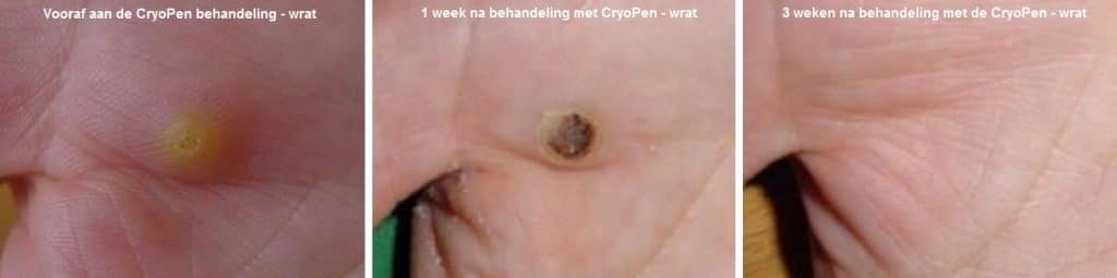 wratten_cryopen_behandeling_kliniek_de_medici